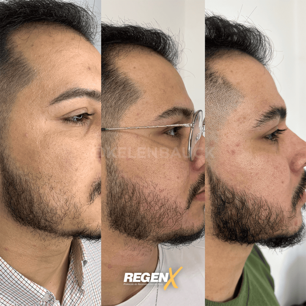 1-regenx-barbe