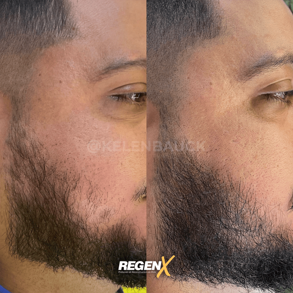 2-regenx-barbe