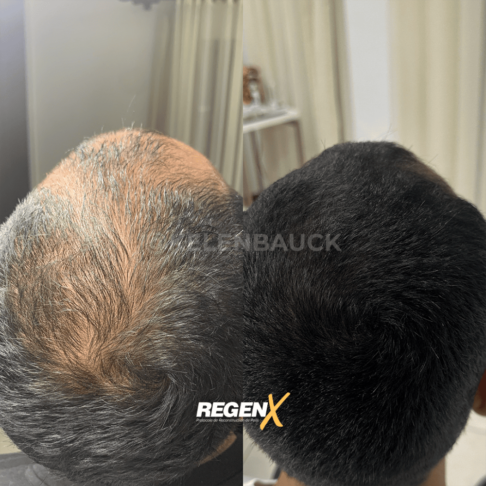 17-regenx-cheveux