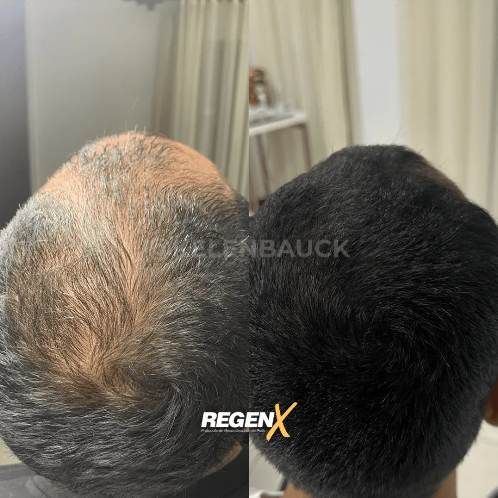 repousse capillaire homme