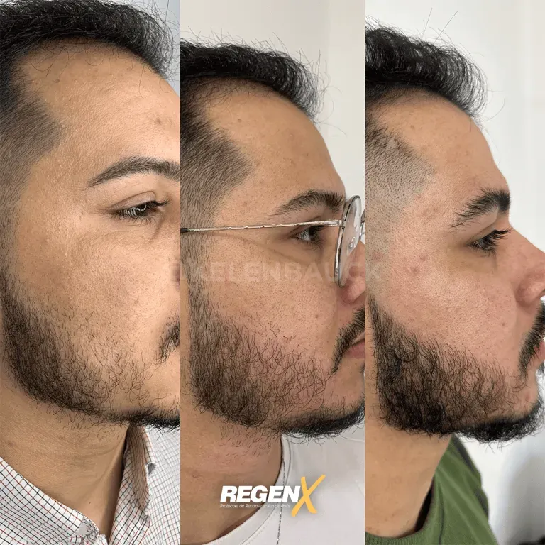 repousse capillaire barbe 3 fois