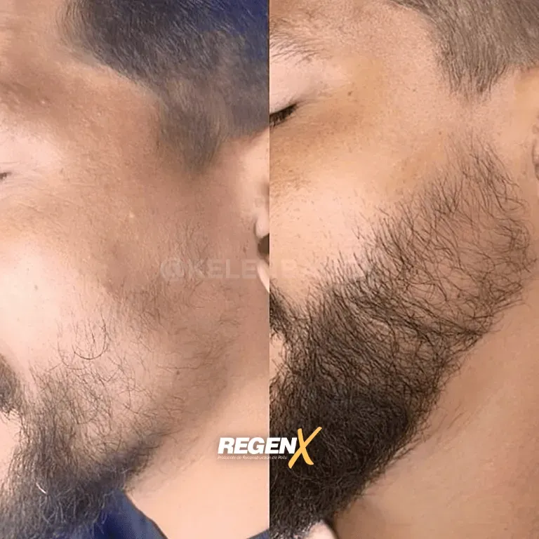 repousse capillaire barbe 2fois